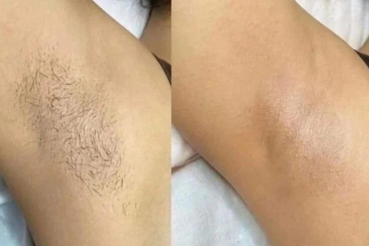 سن مناسب برای لیزر موهای زائد