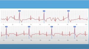 علت تپش قلب در زنان چیست؟ بررسی کامل علائم، دلایل هورمونی و نشانه‌های خطرناک