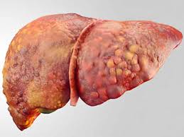 کاهش خطر سرطان کبد با مصرف کم پروتئین؛ یافته جدید دانشمندان درباره نقش رژیم غذایی در مهار تومورهای کبدی
