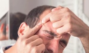 خوراکی‌ها و مواد غذایی که باعث جوش زدن می‌شوند | لیست کامل غذاهای آکنه‌زا