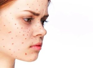 درمان سریع جوش صورت | بررسی کامل علل آکنه و ۳۶ روش خانگی مؤثر برای درمان جوش (Acne Treatment)