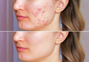 درمان سریع جوش صورت | بررسی کامل علل آکنه و ۳۶ روش خانگی مؤثر برای درمان جوش (Acne Treatment)